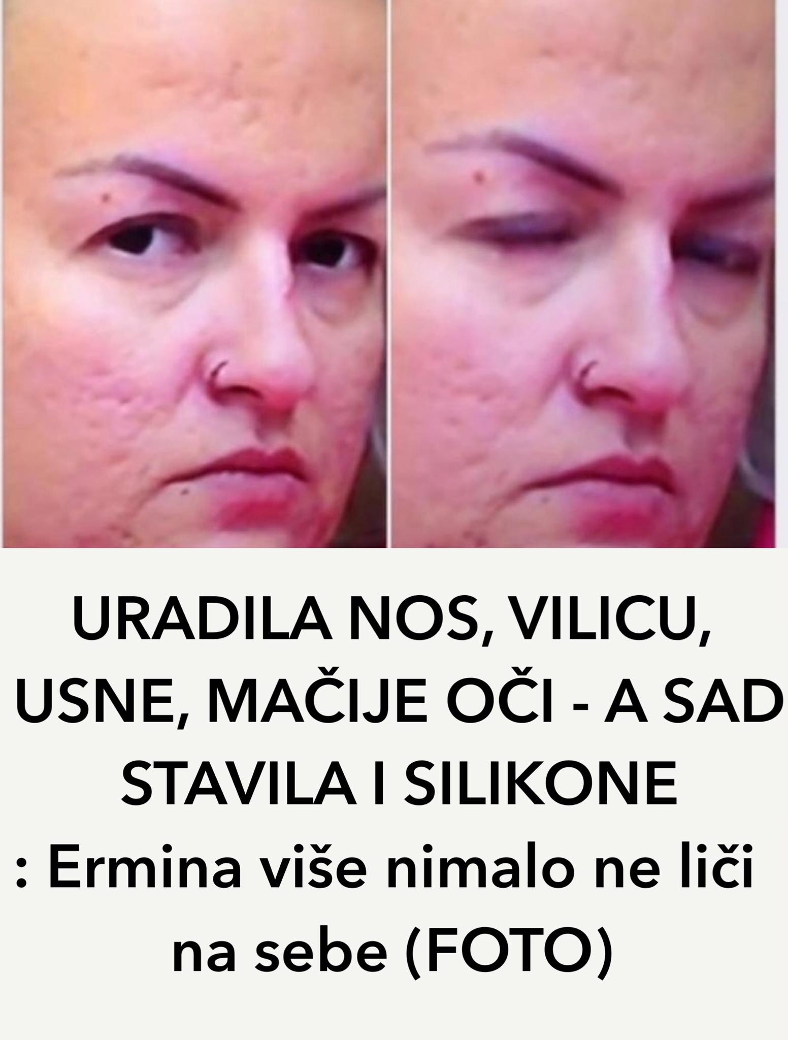 POGLEDAJTE KAKO ERMINA IZGLEDA POSLIJE OPERACIJA