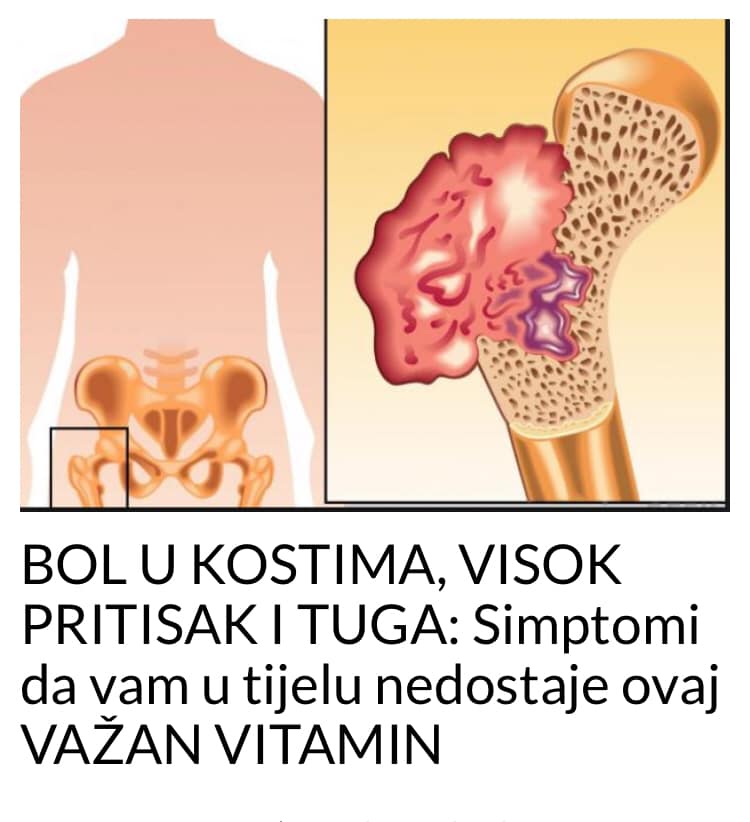 EVO KOJI VAM VITAMIN NEDOSTAJE AKO IMATE PROBLEMA SA BOLOVIMA U KOSTIMA