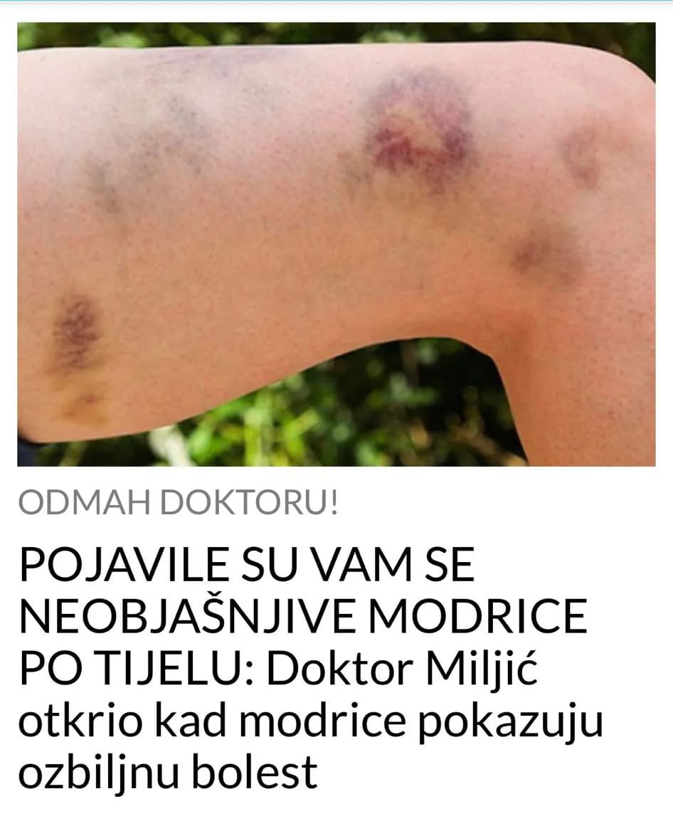 OBRATITE PAZNJU NA MODRICE, EVO KADA ONE UKAZUJU NA OZBILJNU BOLEST