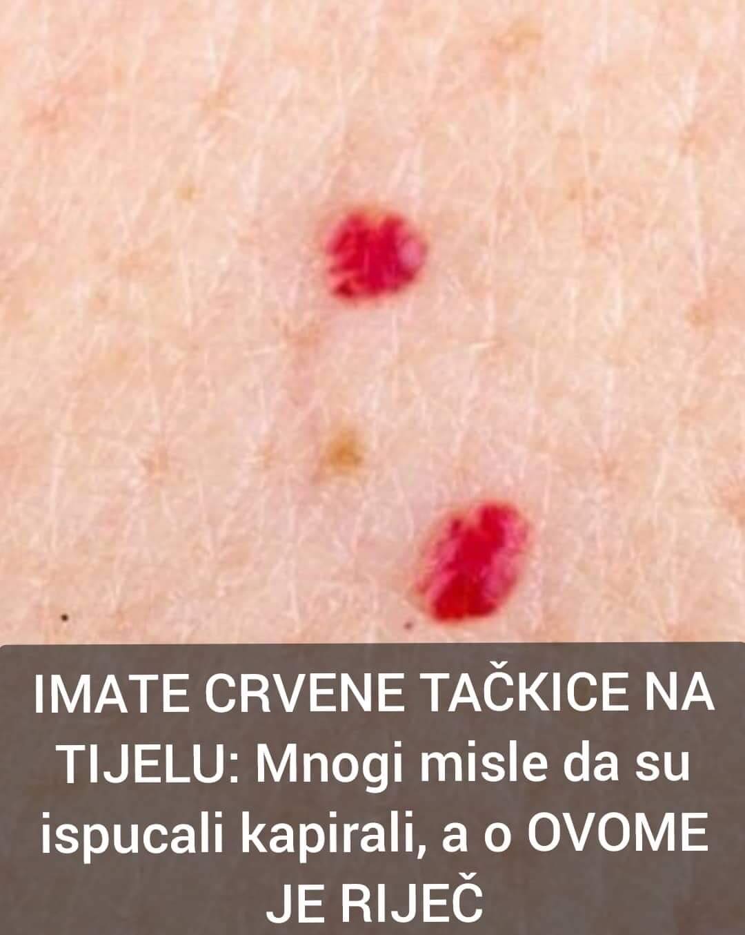 STA ZNACE CRVENE TACKICE PO VASEM TIJELU – SVI MISLE DA SU TO ISPUCALI KAPILARI