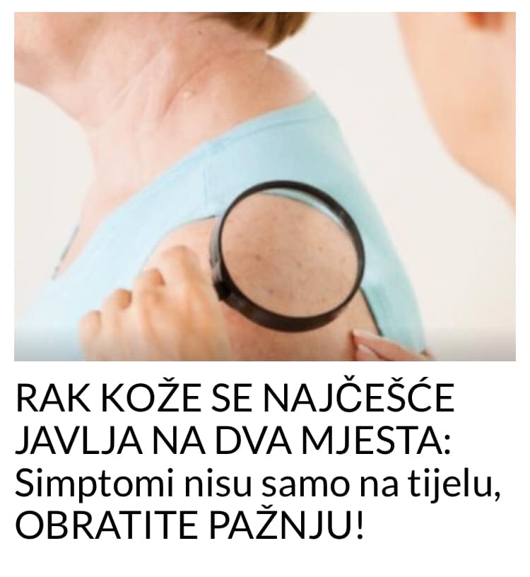 OBRADITE PAZNJU NA OVE SIMPTOME –  RAK KOZE JE U PITANJU