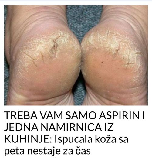 POGLEDAJTE KAKO ISPUCANA KOZA SA PETA NESTAJE ZA CAS !