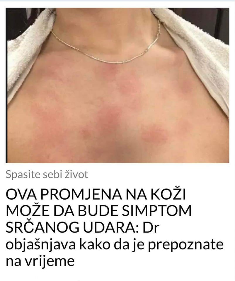 PRATITE PROMJENE NA KOŽI, JEDNA OD NJIH MOŽE DA BUDE SIMPTOM SRČANOG UDARA