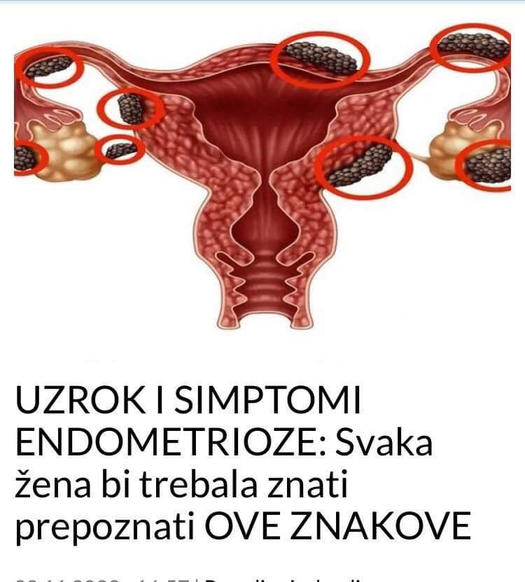 POGLEAJTE UZROK I SIMPTOME ENDOMETRIOZE