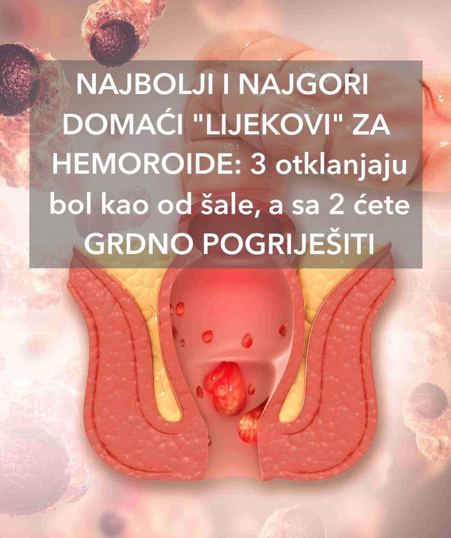 POGLEDAJTE NAJBOLJI I NAJGORI DOMAĆI “LIJEKOVI” ZA HEMOROIDE