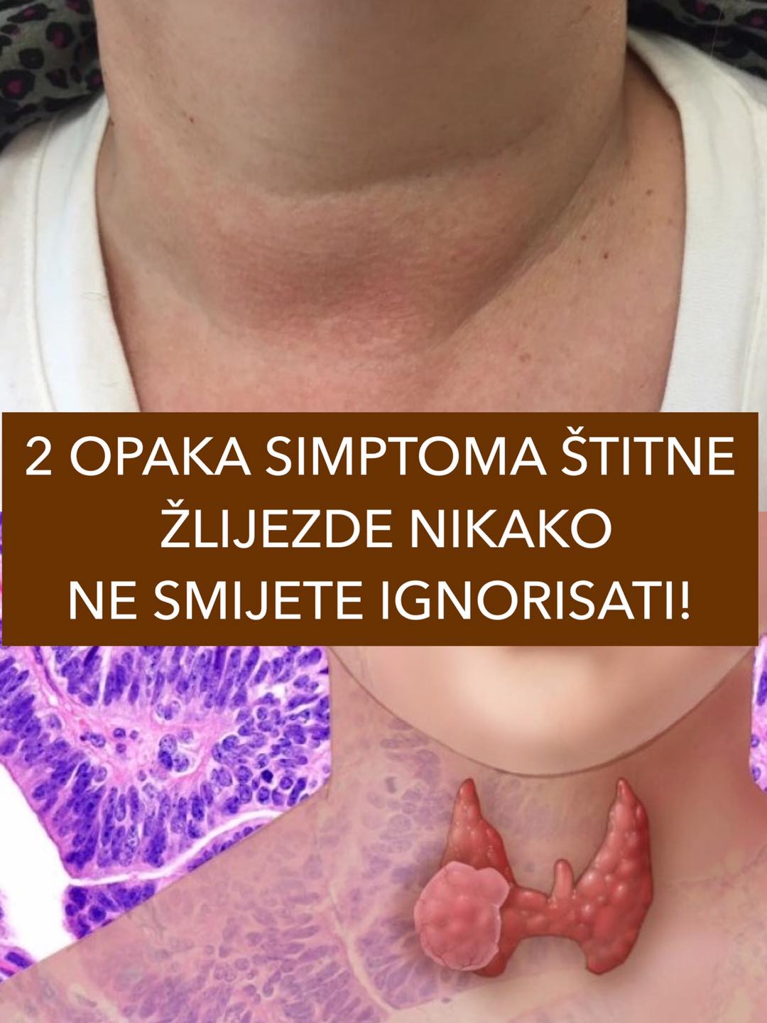 POGLEDAJTE 2 OPAKA SIMPTOMA ŠTITNE ŽLIJEZDE NIKAKO NE SMIJETE IGNORISAT