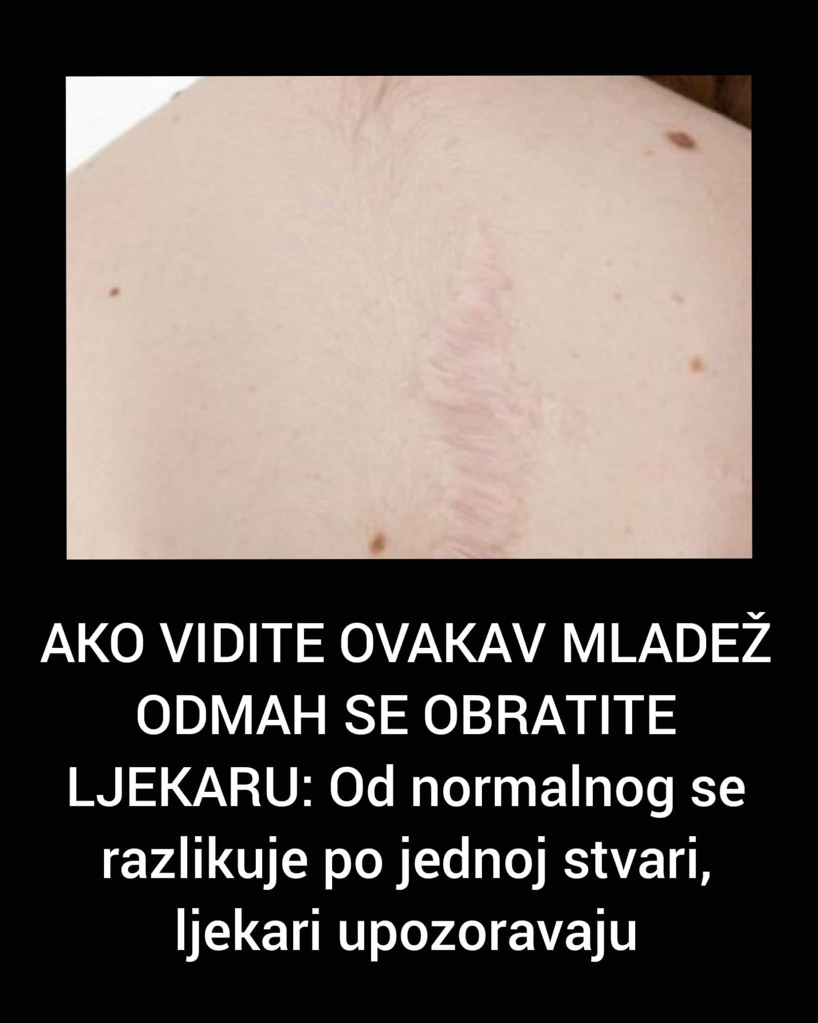 AKO VIDITE OVAKAV MLADEŽ ODMAH SE OBRATITE LJEKARU: