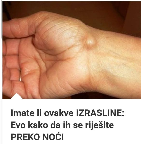 EVO KAKO DA SE RIJESITE OVIH IZRASLINA