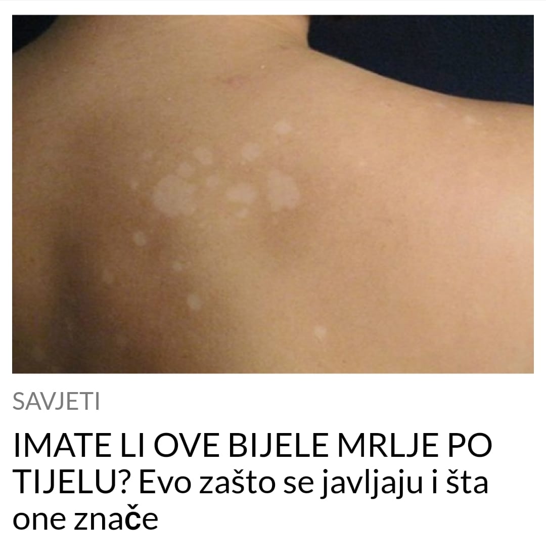 EVO ZAŠTO VAM SE JAVLJAJU BIJELE MRLJE PO TIJELU