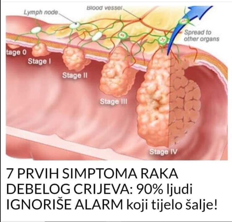 POGLEDAJTE 7 PRVIH SIMPTOMA RAKA DEBELOG CRIJEVA: