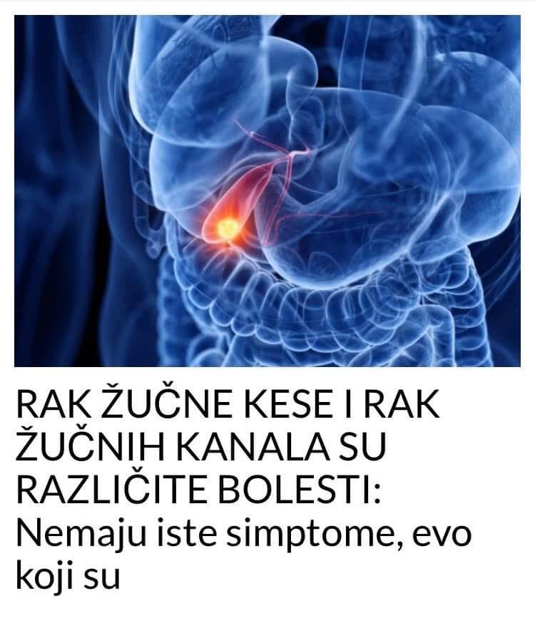 RAK ŽUČNE KESE I RAK ŽUČNIH KANALA SU RAZLIČITE BOLESTI: