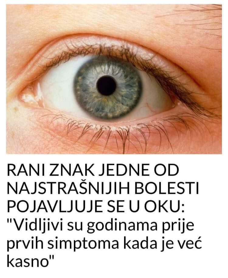 POGLEDAJTE RANI ZNAK STRAŠNE BOLESTI KOJA NAPADA OČI