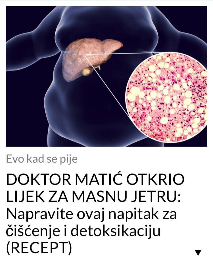 POGLEDAJTE KAKO DOKTOR MATIĆ LIJEČI MASNU JETRU