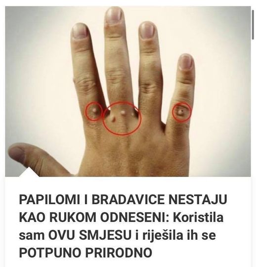 PAPILOMI I BRADAVICE NESTAJU KAO RUKOM 0DNESENI: