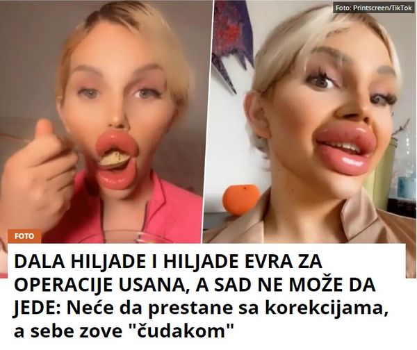 DALA HILJADE I HILJADE EVRA ZA OPERACIJE USANA, A SAD NE MOŽE DA JEDE: Neće da prestane sa korekcijama, a sebe zove “čudakom”