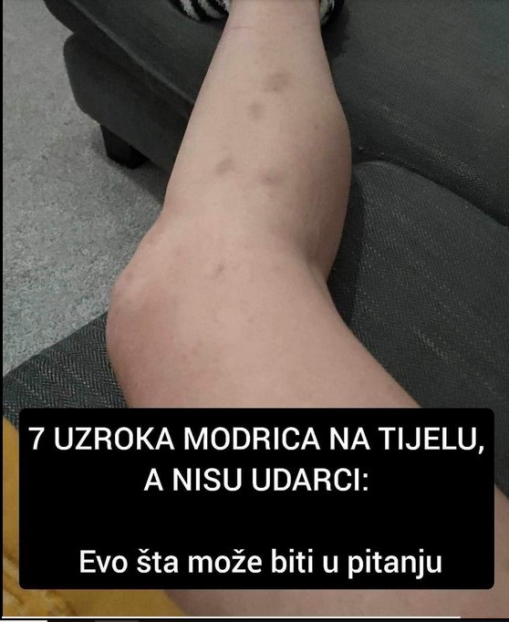 MODRICE MOGU BITI ZNAK FATALNE BOLESTI: Ako primetite OVO, odmah se javite LEKARU!