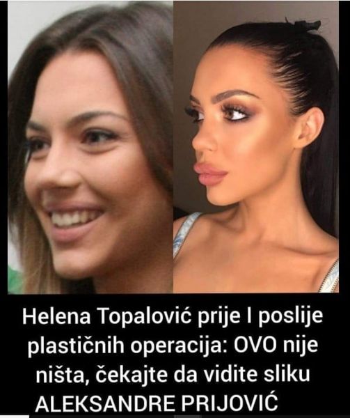 OVO JE TOPALKOVA KĆERKA PRIJE PLASTIČNIH OPERACIJA.