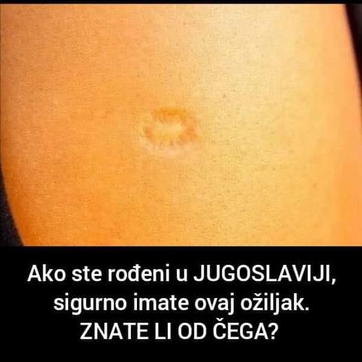 AKO STE ROĐENI U JUGI I, ONDA SIGURNO IMATE OVAJ OŽILJAK NA RUCI: Znate li od čega?