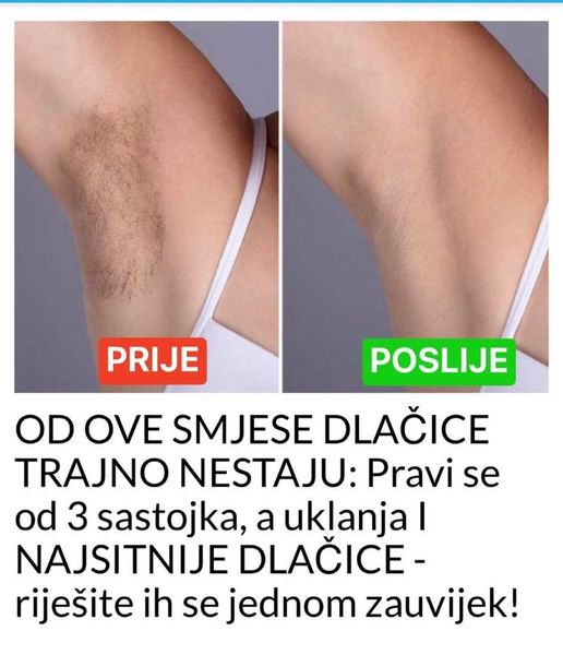 OD OVE SMJESE DLAČICE TRAJNO NESTAJU: Pravi se od 3 sastojka, a uklanja I NAJSITNIJE DLAČICE – riješite ih se jednom zauvijek!