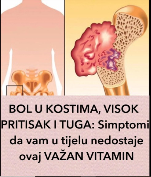 BOL U KOSTIMA, VISOK PRITISAK I TUGA: Simptomi da vam u tijelu nedostaje ovaj VAŽAN VITAMIN