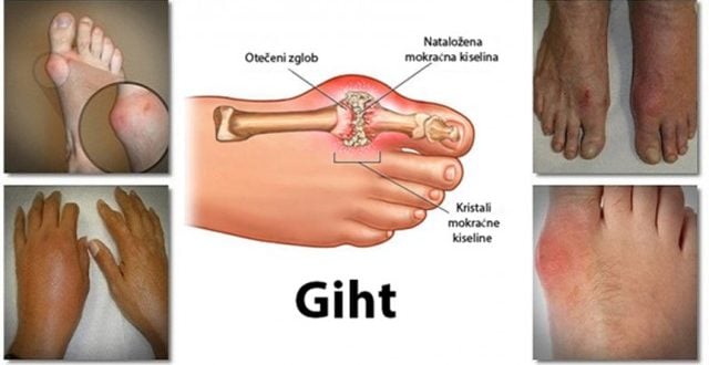 Recept za moćni prirodni napitak koji leči giht: Potrebno svega nekoliko sastojaka, a rešiće probleme kao i analgetik