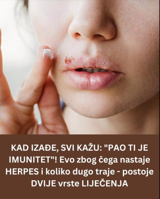 ZAUSTAVITE ŠIRENJE ZARAZE: Ako imate herpes izbegavajte ljubljenje! A evo tačno i ZAŠTO!