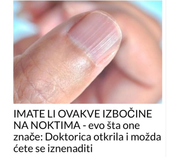 IMATE LI OVAKVE IZBOČINE NA NOKTIMA – Evo Šta One Znače: Doktorica Otkrila I Možda Ćete Se Iznenaditi