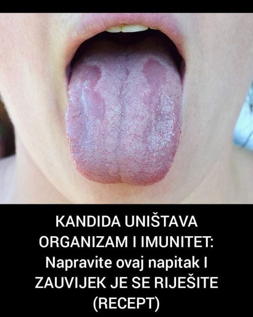 KANDIDA UNIŠTAVA ORGANIZAM I IMUNITET: Napravite Ovaj Napitak I ZAUVIJEK JE SE RIJEŠITE (RECEPT)