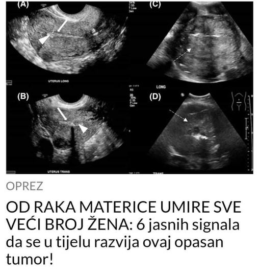 OD RAKA MATERICE UMIRE SVE VEĆI BROJ ŽENA: 6 jasnih signala da se u tijelu razvija ovaj opasan tumor!